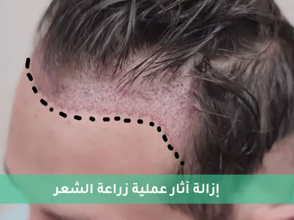 إزالة آثار عملية زراعة الشعر