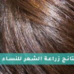 نتائج زراعة الشعر للنساء
