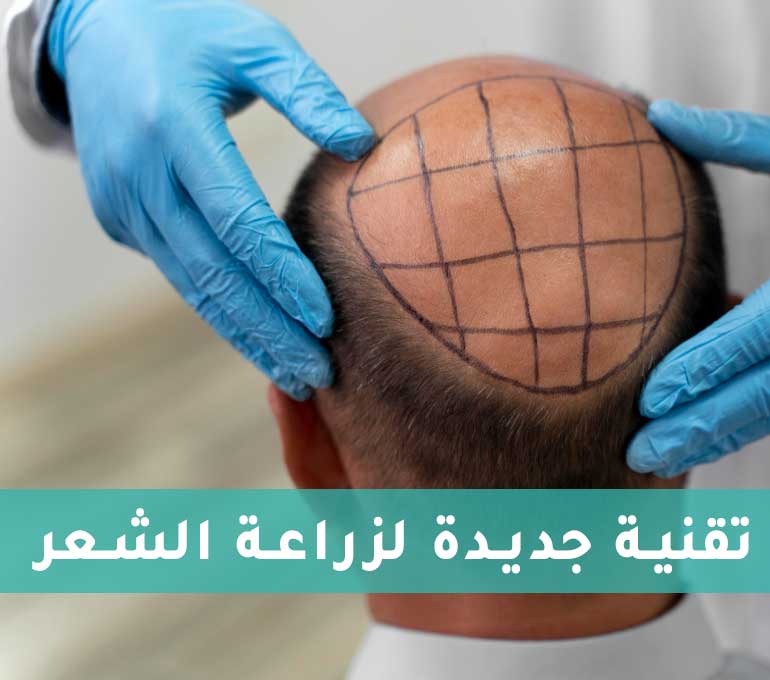 تقنية جديدة لزراعة الشعر