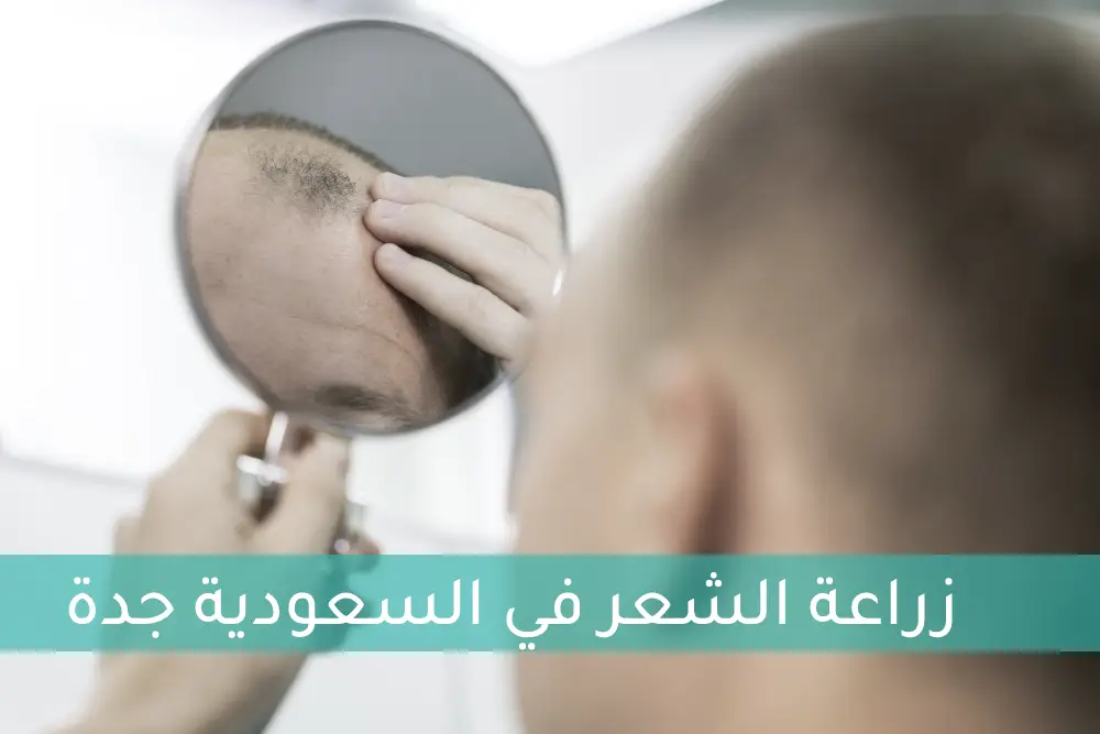 زراعة الشعر في السعودية جدة